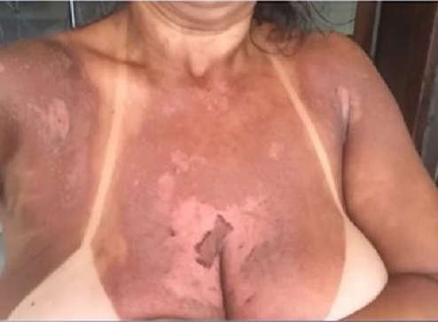 Itabuna: Mulheres denunciam clínica por queimaduras durante bronzeamento com fita