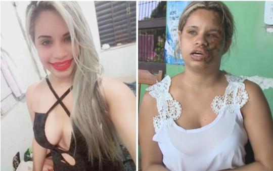  Homem deixa ex-namorada deformada após discussão sobre guarda de criança